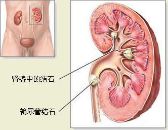 如何治療腎結(jié)石 有哪些治療方法